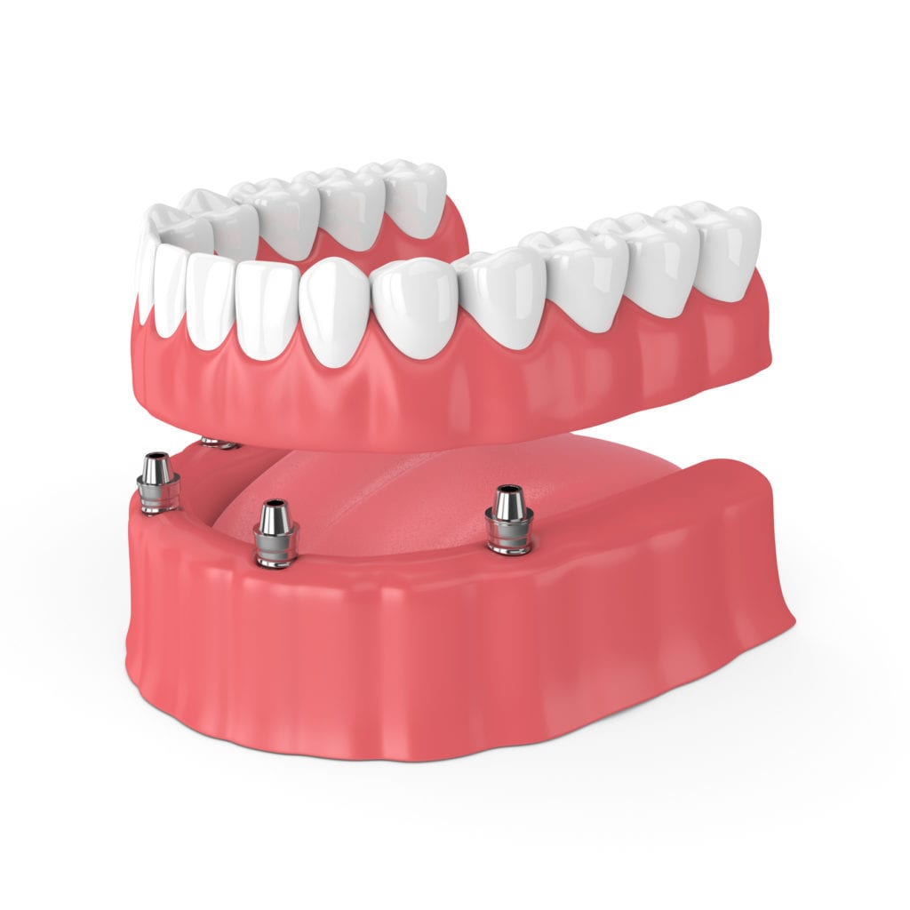 Full and Partial Dentures in Leland, North Carolina