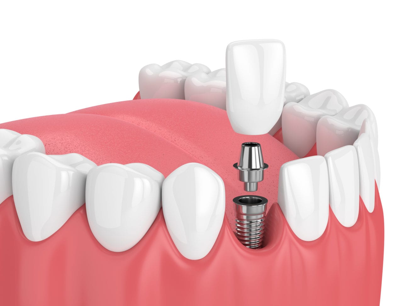 Tooth Implants in Leland, North Carolina