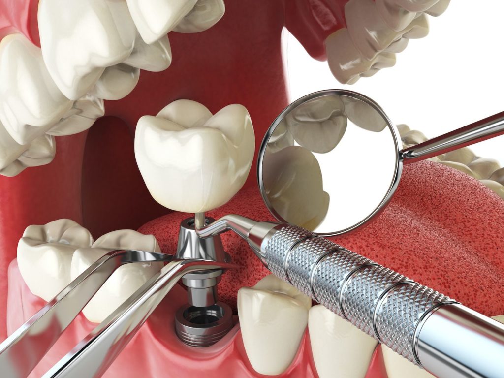dental implants benefits in Leland North Carolina
