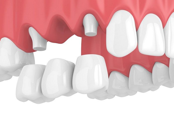 Your Dental Bridge Options