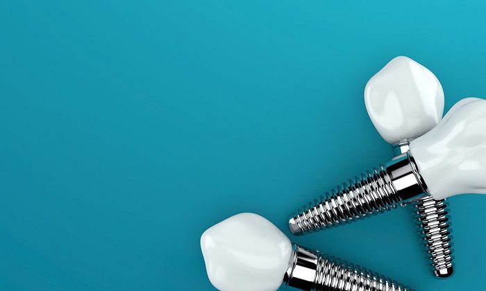 Comparing Types of Dental Implants