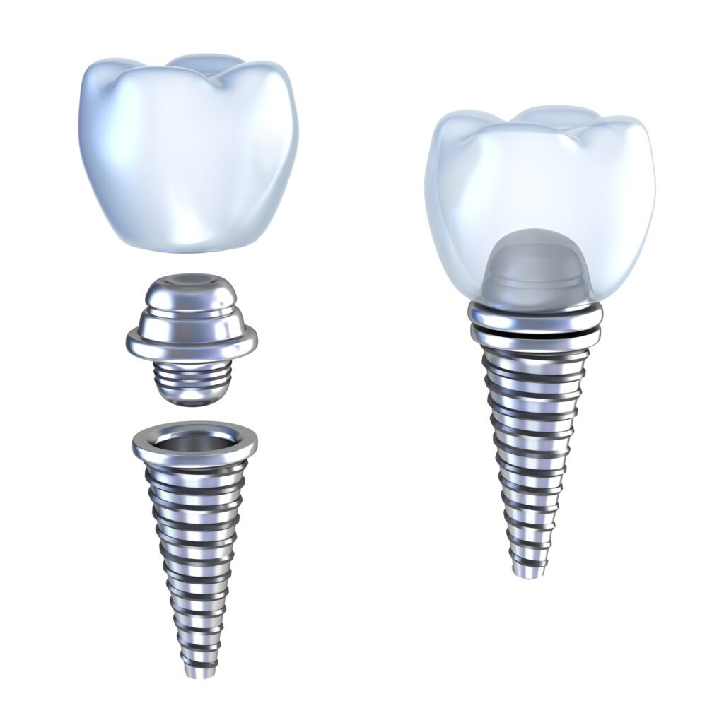 Parts of a dental implant in Leland, NC