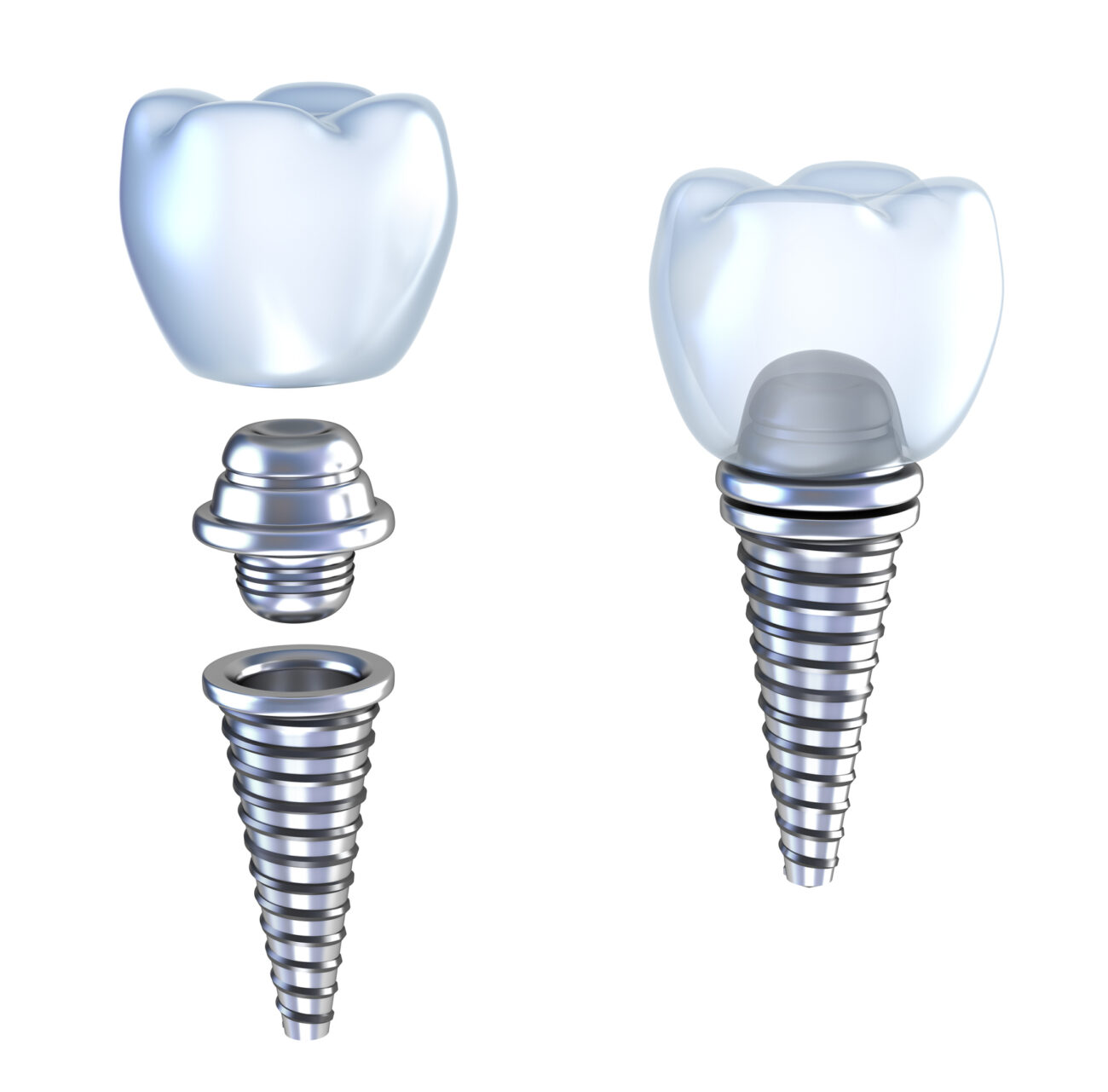 Parts of a dental implant in Leland, NC