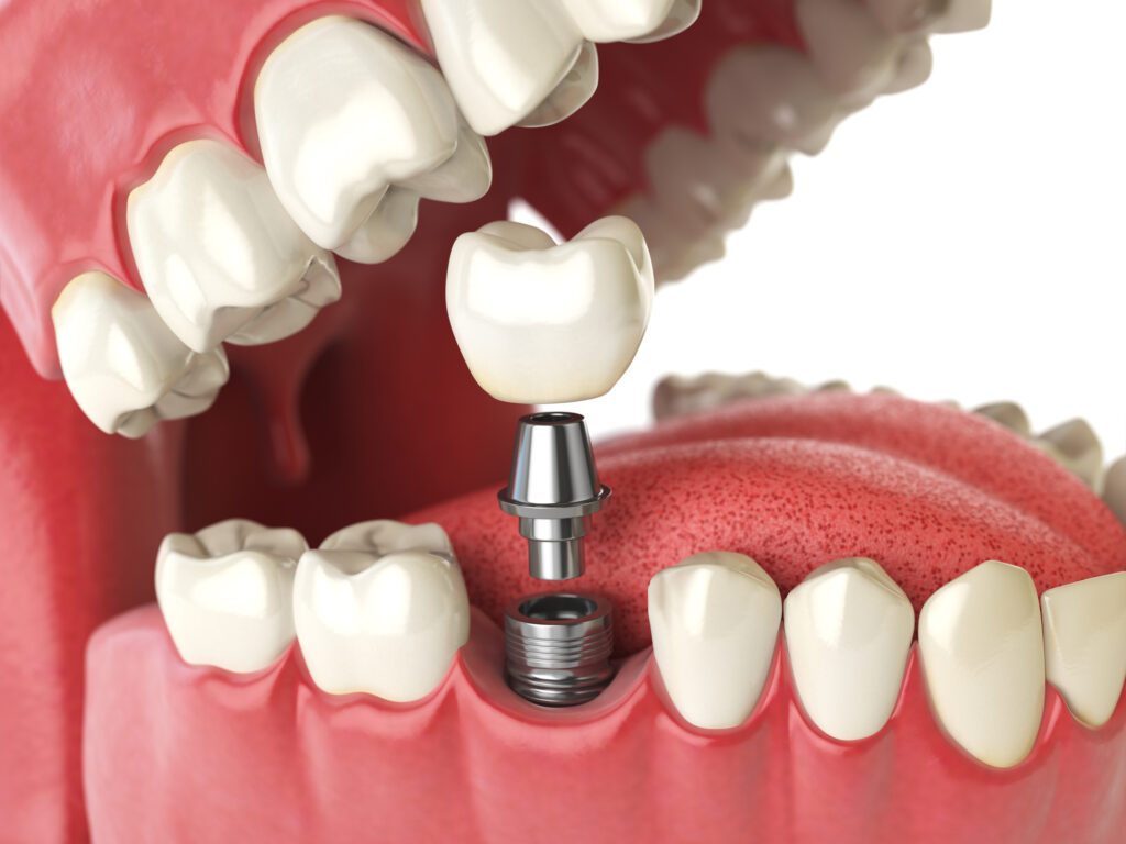 dental implant process in Leland, NC