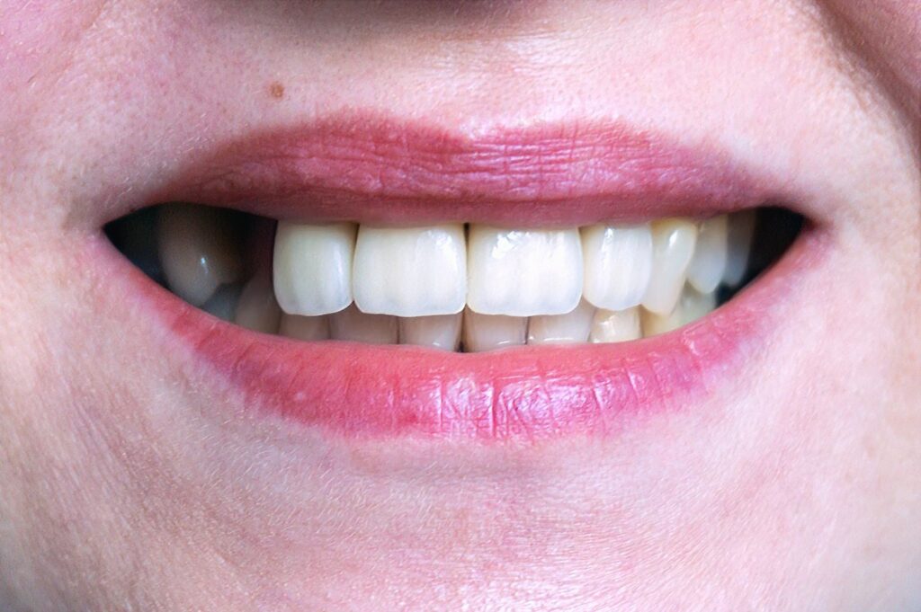 What Causes Missing Teeth