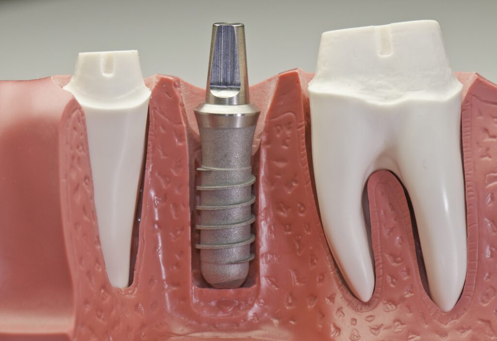 Why Choose Dental Implants? Dental implants in Leland, NC