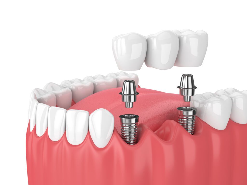multiple dental implants in Leland, NC
